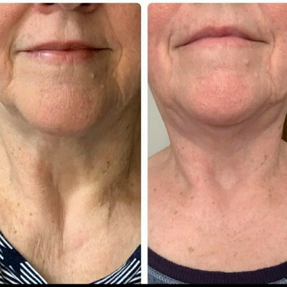 Dermatic Effects Cellulite Cream - Picture 5 of 6